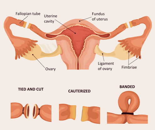 surgical methods of contraception